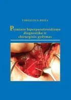 Pirminio hiperparatiroidizmo diagnostika ir chirurginis gydymas